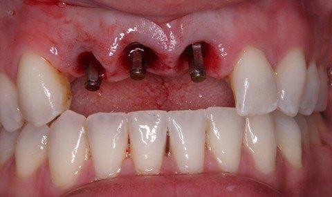 Missing teeth with dental implants visible