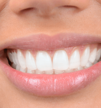 Closeup of smile with dental bonding