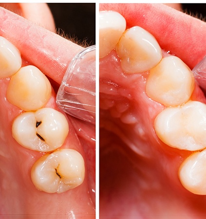 before and after getting a tooth-colored filling