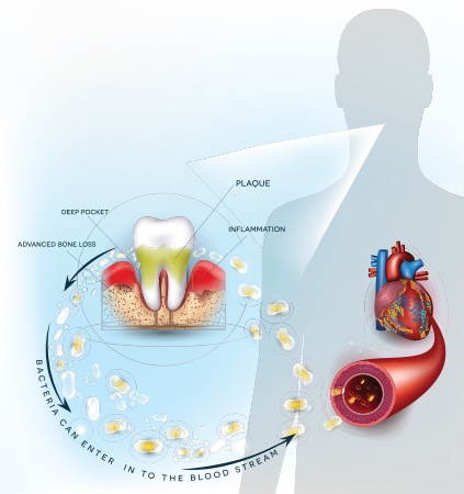 Animated representation of gum disease impacting overall health