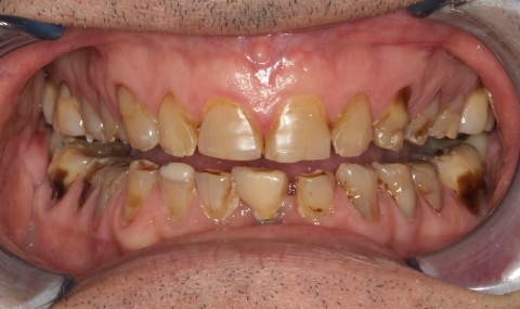 Discolored smile before cosmetic dentistry