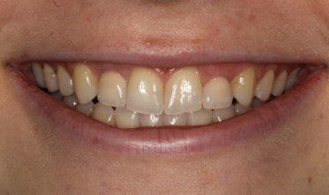 Healthy beautiful smile after cosmetic dentistry