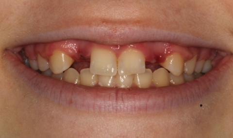 Discolored smile before cosmetic dentistry