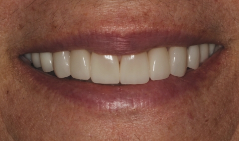 Healthy beautiful smile after cosmetic dentistry