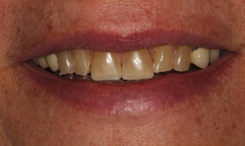 Discolored smile before cosmetic dentistry