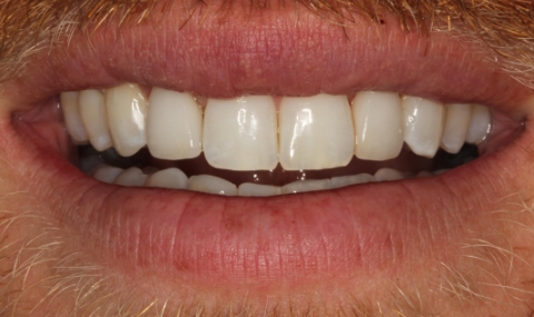 Healthy beautiful smile after cosmetic dentistry