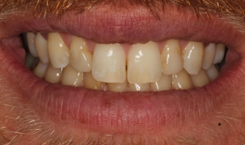 Discolored smile before cosmetic dentistry