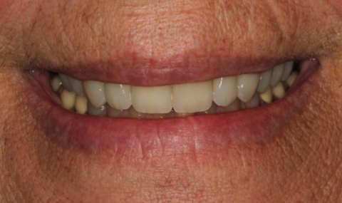 Healthy beautiful smile after cosmetic dentistry