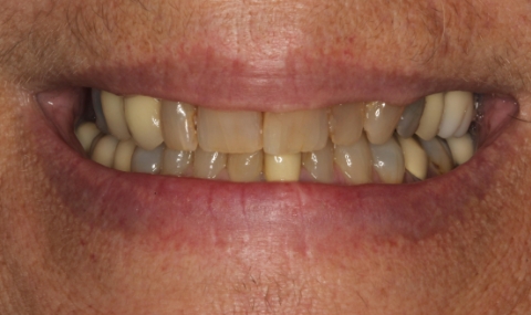 Discolored smile before cosmetic dentistry