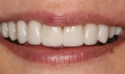 Healthy beautiful smile after cosmetic dentistry