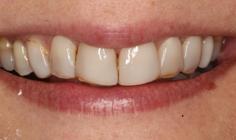 Discolored smile before cosmetic dentistry