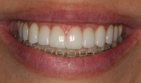 Healthy beautiful smile after cosmetic dentistry