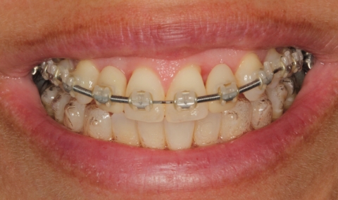 Discolored smile before cosmetic dentistry