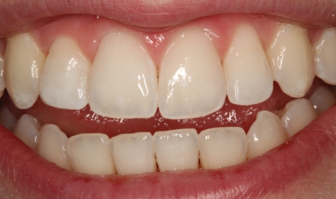 Healthy beautiful smile after cosmetic dentistry