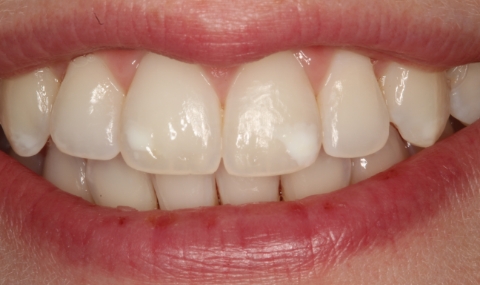 Discolored smile before cosmetic dentistry