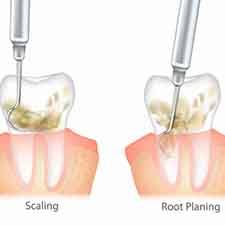 a 3D illustration of scaling and root planing treatment