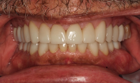 Healthy beautiful smile after cosmetic dentistry