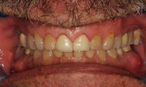 Discolored smile before cosmetic dentistry