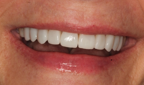 Healthy beautiful smile after cosmetic dentistry