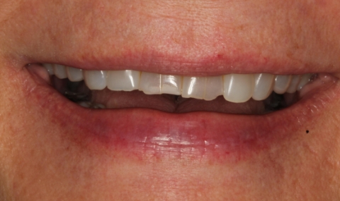 Discolored smile before cosmetic dentistry