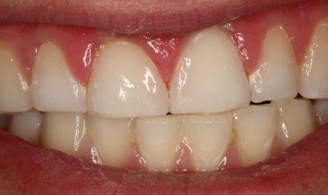 Healthy beautiful smile after cosmetic dentistry