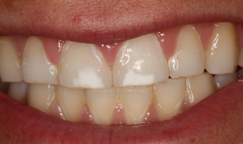 Discolored smile before cosmetic dentistry