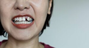 Woman with missing tooth