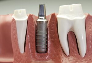 Model of titanium dental implant post