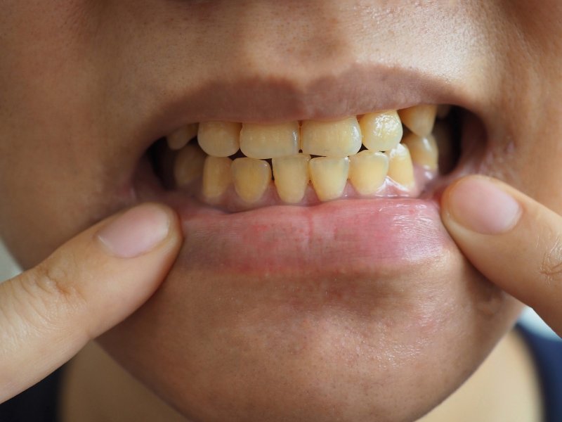 A man pointing to his deeply stained teeth