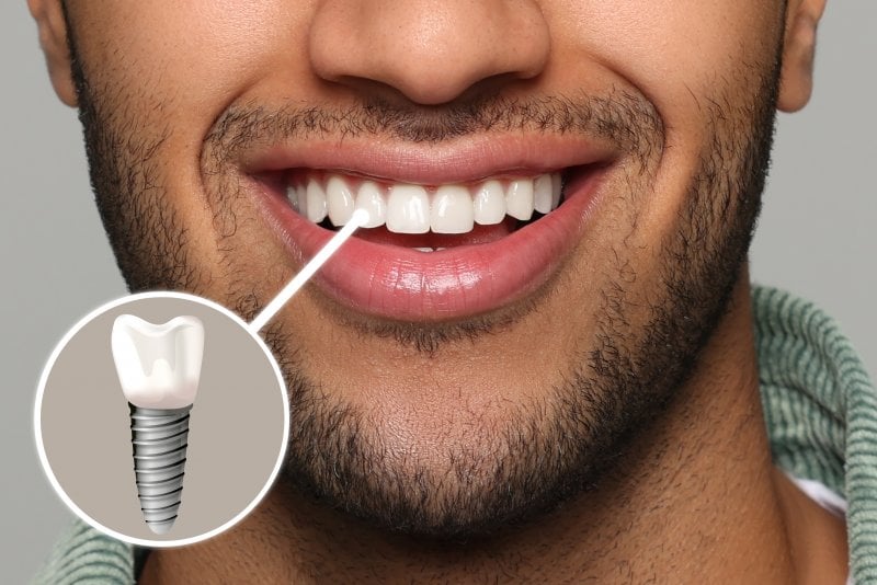 A closeup emphasizing a man’s dental implant replacing his front tooth