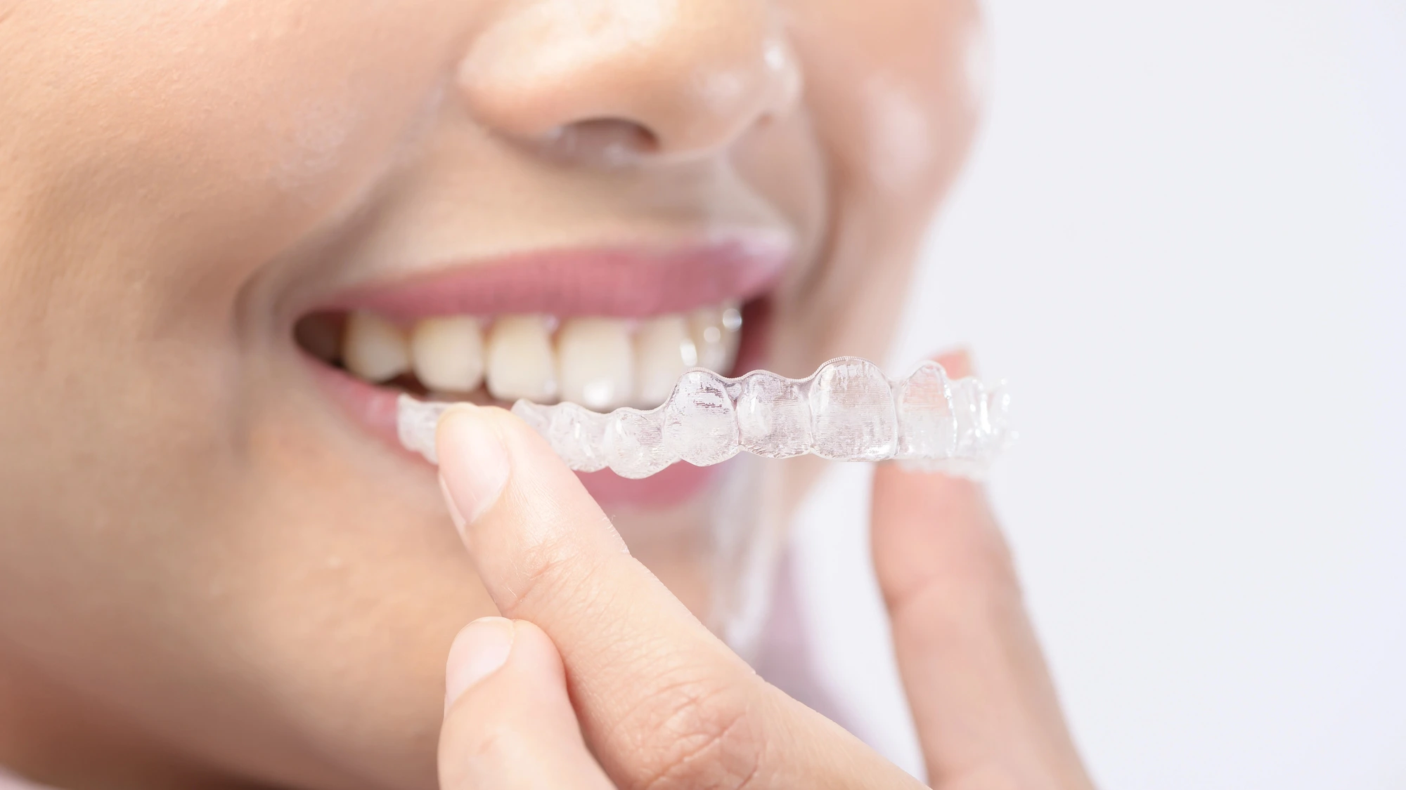 close up of woman puting Invisalign in Richmond, VA in her mouth