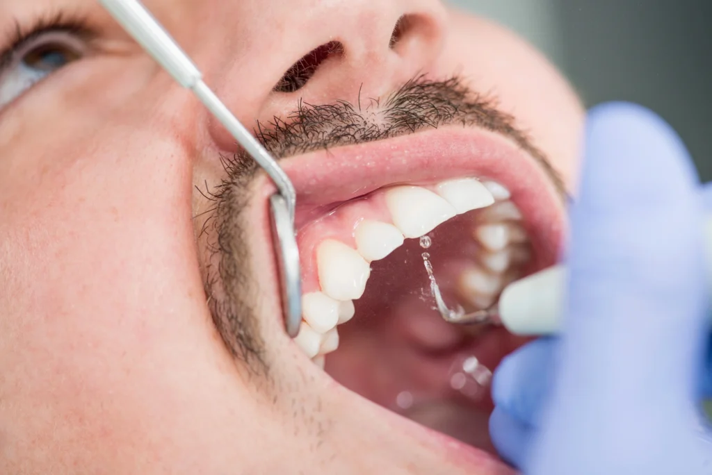 man getting a teeth cleaning in Richmond