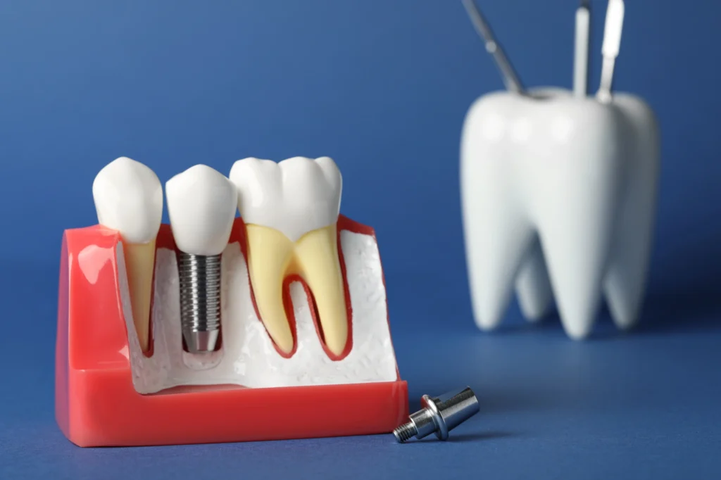 model of dental implants in Short Pump