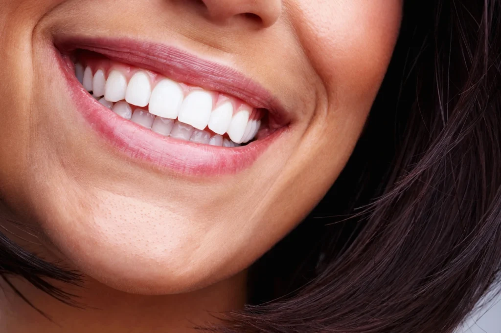 close up of mouth with veneers in Short Pump